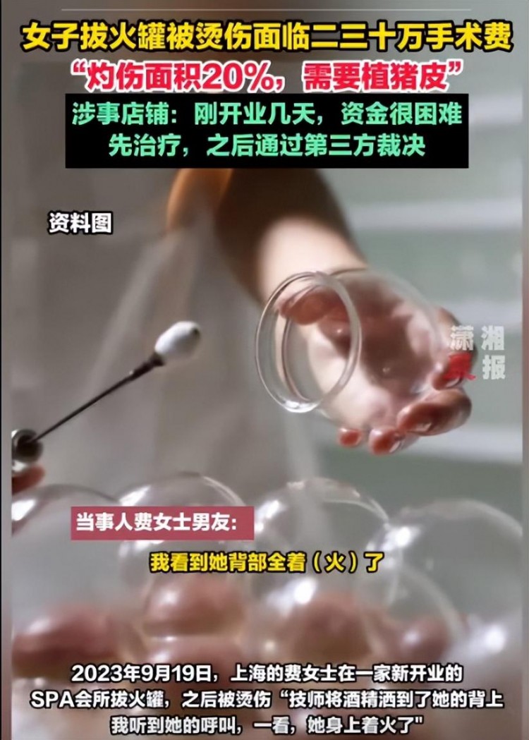 上海女子拔火罐被烫伤，但SPA俱乐部拒绝赔偿。她男朋友怎么说？